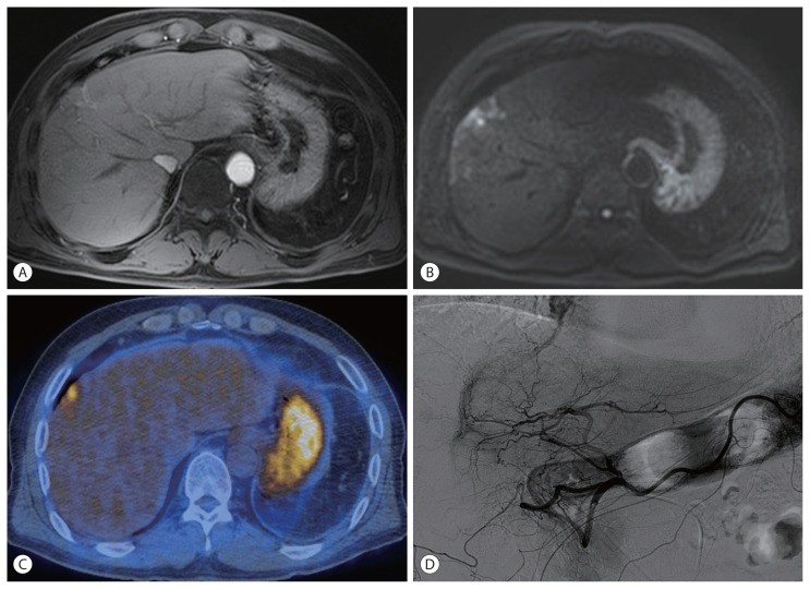 Advanced Stage Hepatocellular Carcinoma Successfully Treated with Transarterial Radioembolization and Multi-tyrosine Kinase Inhibitor Therapy.