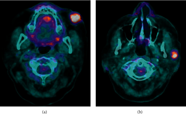 Metastatic Merkel Cell Carcinoma Masquerading as Multiple Immune-Related Adverse Events.