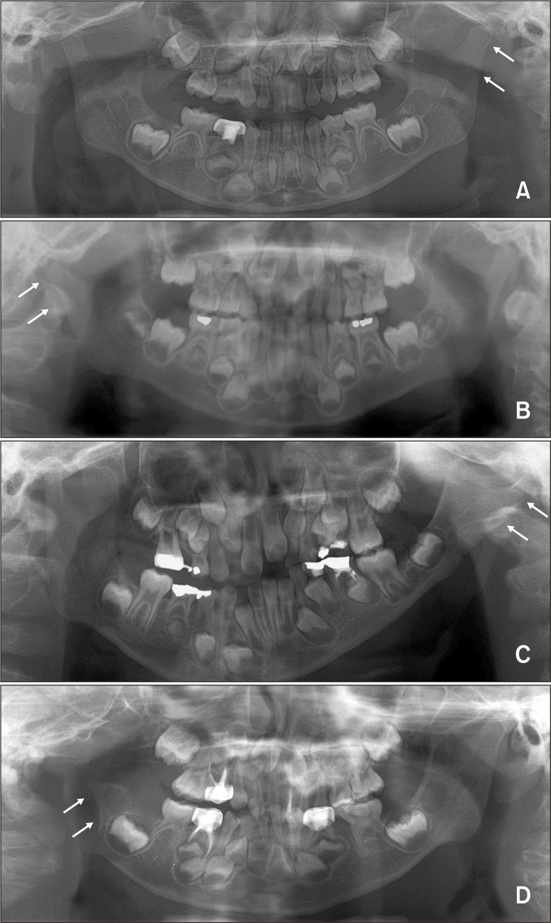 Treatment modalities for Korean patients with unilateral hemifacial microsomia according to Pruzansky-Kaban types and growth stages.