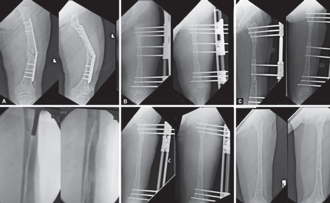 A Novel Technique-Bone Splitting and Bone Grafting in an Hourglass-shaped Bone Following Distraction Osteogenesis.