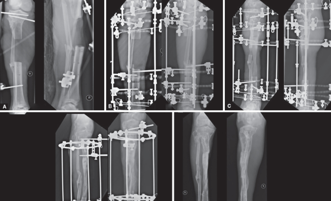 A Novel Technique-Bone Splitting and Bone Grafting in an Hourglass-shaped Bone Following Distraction Osteogenesis.