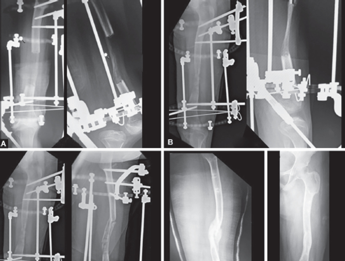 A Novel Technique-Bone Splitting and Bone Grafting in an Hourglass-shaped Bone Following Distraction Osteogenesis.