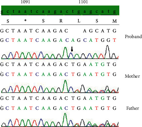 A Novel Mutation of <i>VPS</i>33<i>B</i> Gene Associated with Incomplete Arthrogryposis-Renal Dysfunction-Cholestasis Phenotype.