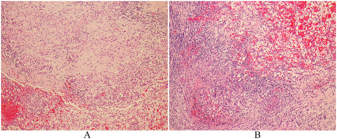 Granulomata in Clear Cell Renal Cell Carcinoma: An Uncommon Presentation of a Common Cancer, Not Two Separate Entities.