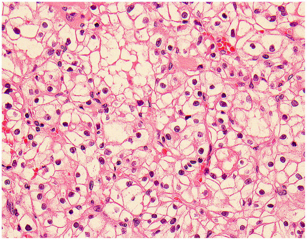 Granulomata in Clear Cell Renal Cell Carcinoma: An Uncommon Presentation of a Common Cancer, Not Two Separate Entities.