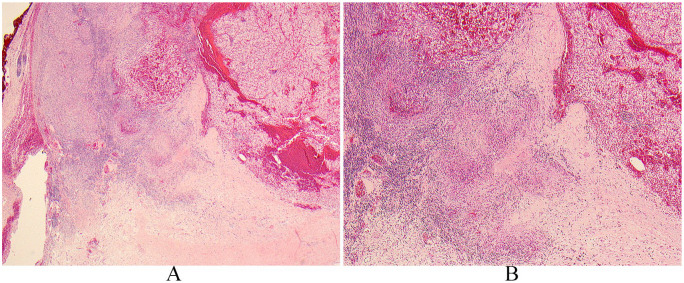 Granulomata in Clear Cell Renal Cell Carcinoma: An Uncommon Presentation of a Common Cancer, Not Two Separate Entities.
