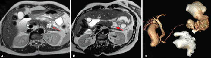 Ruptured Mucinous Cystadenoma Pancreas: A Case Report and Review of Literature.