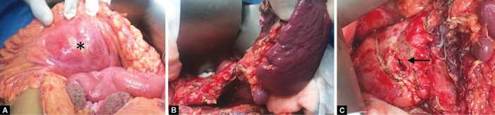 Ruptured Mucinous Cystadenoma Pancreas: A Case Report and Review of Literature.