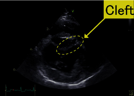 Diagnosis of Isolated Cleft of the Anterior Mitral Leaflet in a Dog: A Case Study Using Real-Time Three-Dimensional Echocardiography.