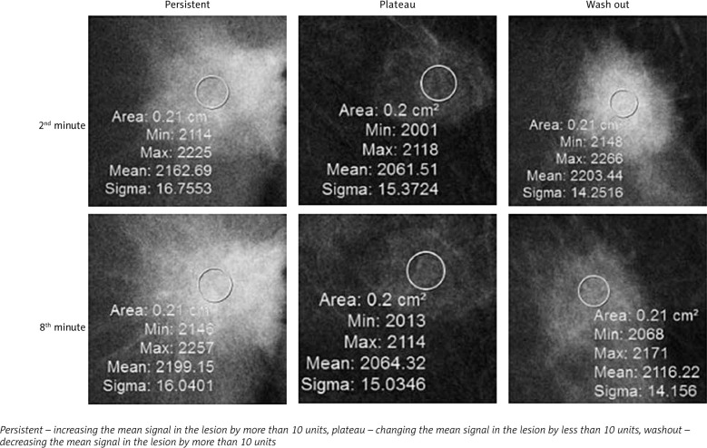 Contrast-enhanced spectral mammography without and with a delayed image for diagnosing malignancy among mass lesions in dense breast.