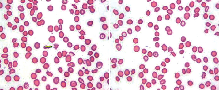 The Diagnosis Is in the Smear: A Case and Review of Spur Cell Anemia in Cirrhosis.