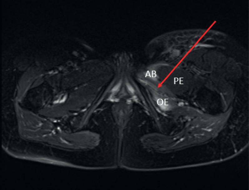 Radiation-Induced Obturator Nerve Injury in Cervical Cancer.