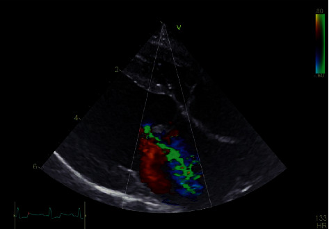 Diagnosis of Isolated Cleft of the Anterior Mitral Leaflet in a Dog: A Case Study Using Real-Time Three-Dimensional Echocardiography.