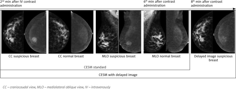 Contrast-enhanced spectral mammography without and with a delayed image for diagnosing malignancy among mass lesions in dense breast.