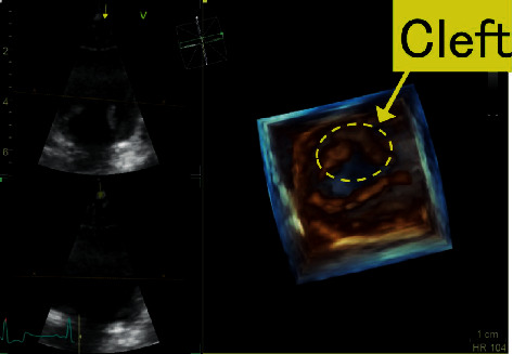 Diagnosis of Isolated Cleft of the Anterior Mitral Leaflet in a Dog: A Case Study Using Real-Time Three-Dimensional Echocardiography.