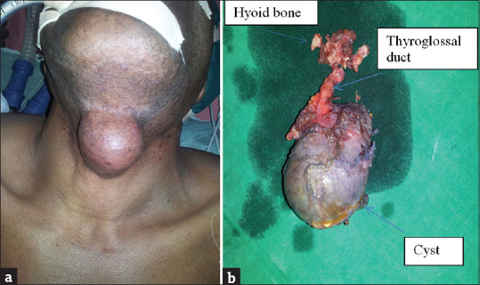 Management of Thyroglossal Cyst in Adults: A Single-Institution Experience.