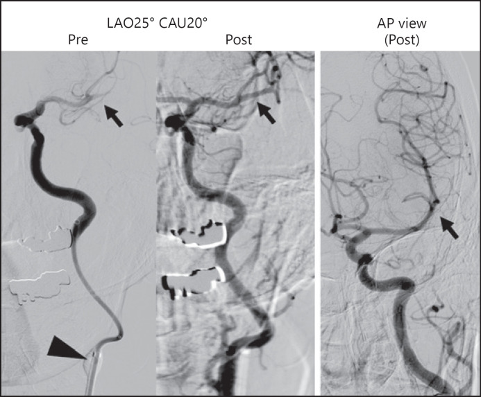 The Feasibility of Mechanical Thrombectomy on Single-Plane Angiosuite: An In-Depth Analysis of Procedure Time.