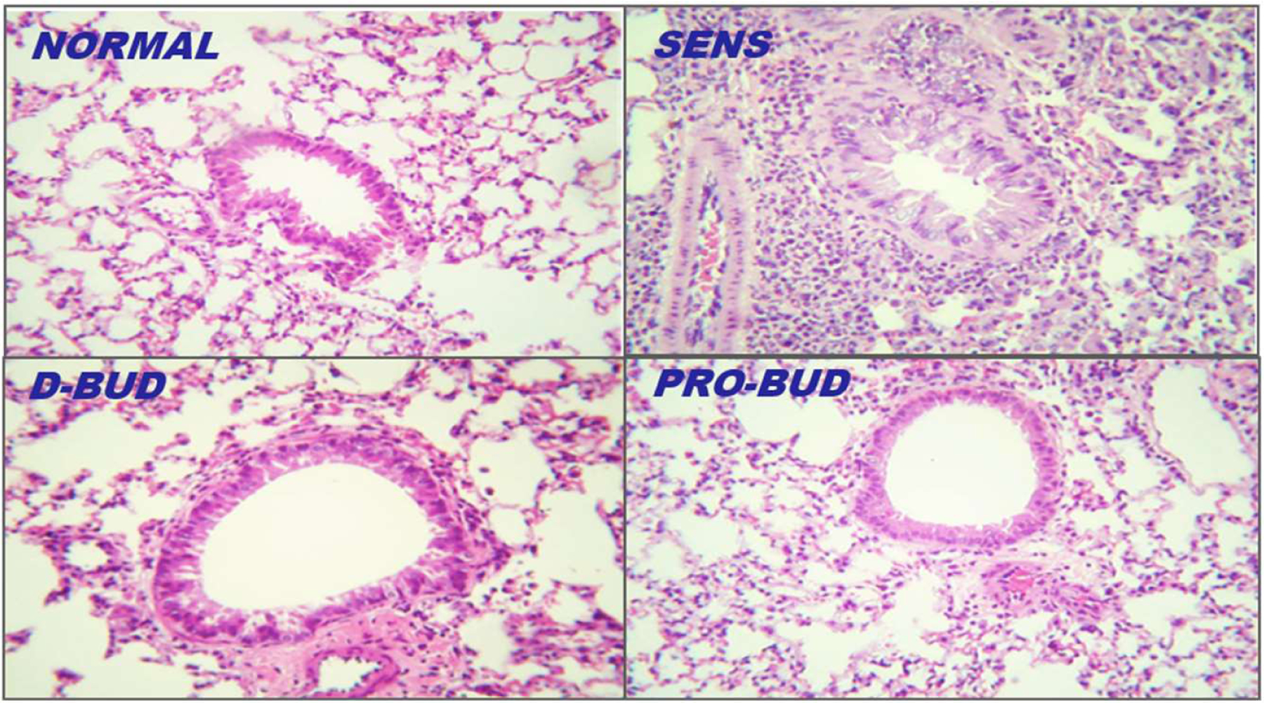 <i>ProLung™-budesonide</i> Inhibits SARS-CoV-2 Replication and Reduces Lung Inflammation.