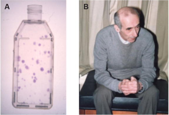 A brief history of the development of stromal stem cells (stem cells of the skeleton).