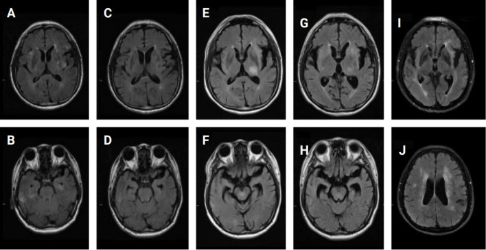 Refractory neuro-Sweet disease successfully treated with tocilizumab and mycophenolate mofetil.