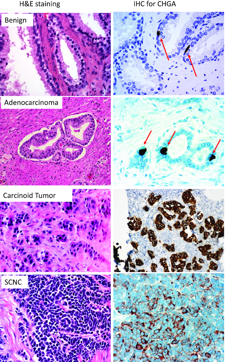 Neuroendocrine cells of the prostate: Histology, biological functions, and molecular mechanisms.