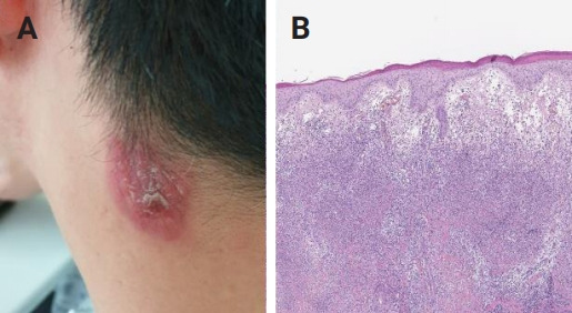 Refractory neuro-Sweet disease successfully treated with tocilizumab and mycophenolate mofetil.