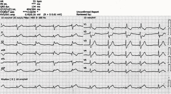 Acute Myocardial Infarction (AMI) Treated with Snake Antivenom.