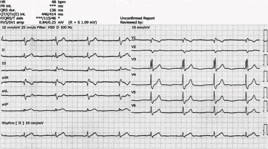 Acute Myocardial Infarction (AMI) Treated with Snake Antivenom.