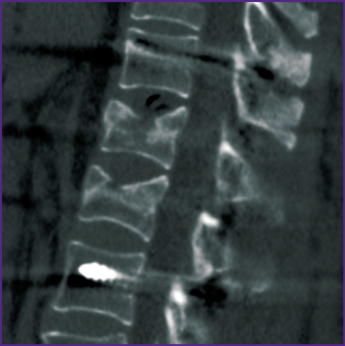 Optimization of Spondylosynthesis for Certain Thoracolumbar Burst Fractures.