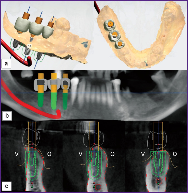 Modified Two-Stage Split Technique for Controlled Ridge Augmentation in Horizontally Atrophic Posterior Mandible: the First Stage of Research.