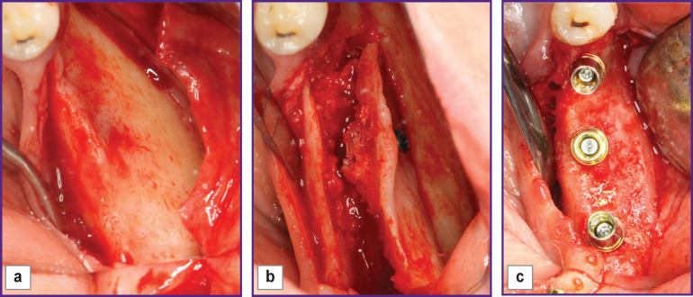 Modified Two-Stage Split Technique for Controlled Ridge Augmentation in Horizontally Atrophic Posterior Mandible: the First Stage of Research.