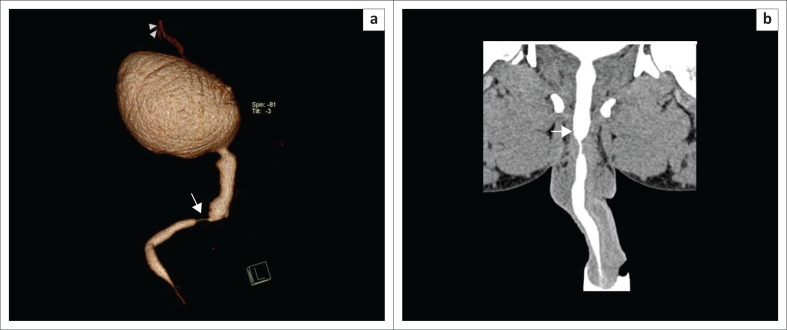 A kaleidoscopic view of male urethral pathologies on 64-slice multidetector computed tomographic urethrography: A novel technique.