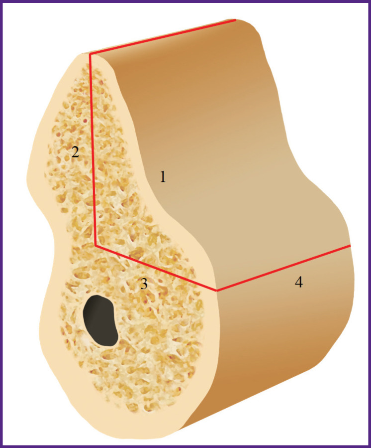 Modified Two-Stage Split Technique for Controlled Ridge Augmentation in Horizontally Atrophic Posterior Mandible: the First Stage of Research.