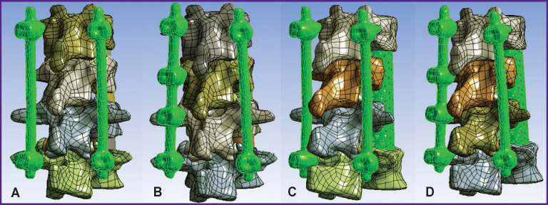 Optimization of Spondylosynthesis for Certain Thoracolumbar Burst Fractures.