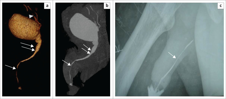 A kaleidoscopic view of male urethral pathologies on 64-slice multidetector computed tomographic urethrography: A novel technique.