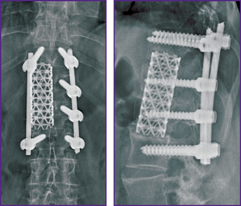 Optimization of Spondylosynthesis for Certain Thoracolumbar Burst Fractures.