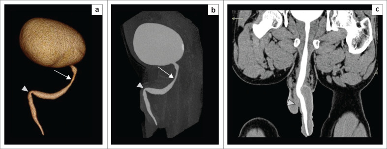 A kaleidoscopic view of male urethral pathologies on 64-slice multidetector computed tomographic urethrography: A novel technique.