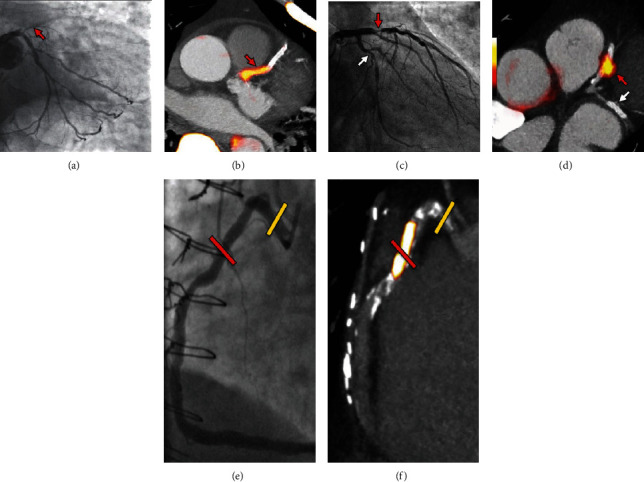 Advances in Quantitative Analysis of <sup>18</sup>F-Sodium Fluoride Coronary Imaging.