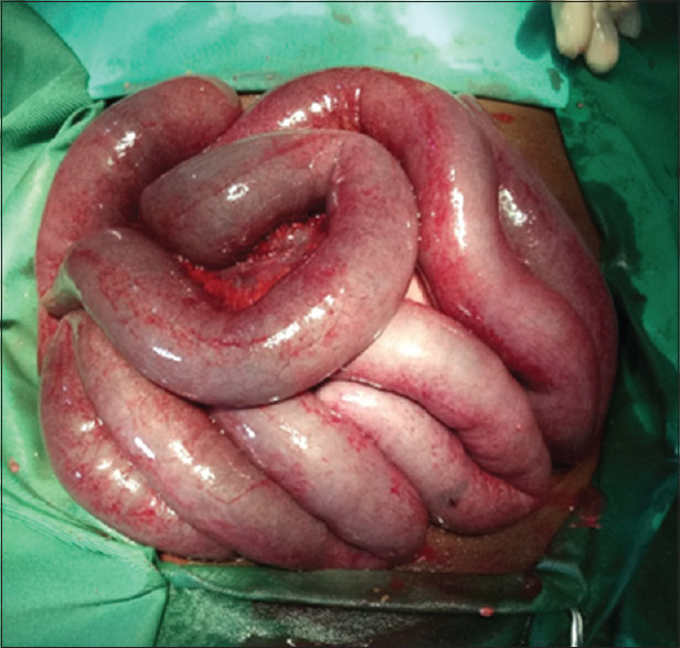 Left Paraduodenal Hernia: A Cause of Double Intestinal Obstruction.