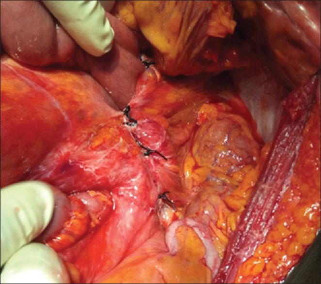 Left Paraduodenal Hernia: A Cause of Double Intestinal Obstruction.