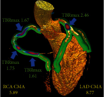 Advances in Quantitative Analysis of <sup>18</sup>F-Sodium Fluoride Coronary Imaging.