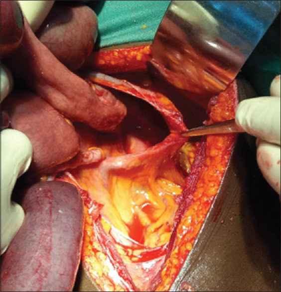 Left Paraduodenal Hernia: A Cause of Double Intestinal Obstruction.