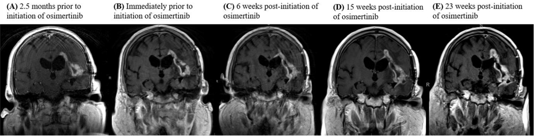 Clinical Experience using Osimertinib in Patients with Recurrent Malignant Gliomas Containing <i>EGFR</i> Alterations.