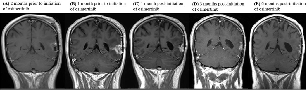 Clinical Experience using Osimertinib in Patients with Recurrent Malignant Gliomas Containing <i>EGFR</i> Alterations.