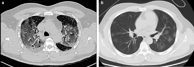 Chest CT performance and features of COVID-19 in the region of Abu Dhabi, UAE: a single institute study.