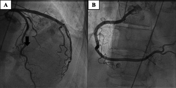 Aborted sudden cardiac death due to ventricular fibrillation in a female patient with mitral valve prolapse.