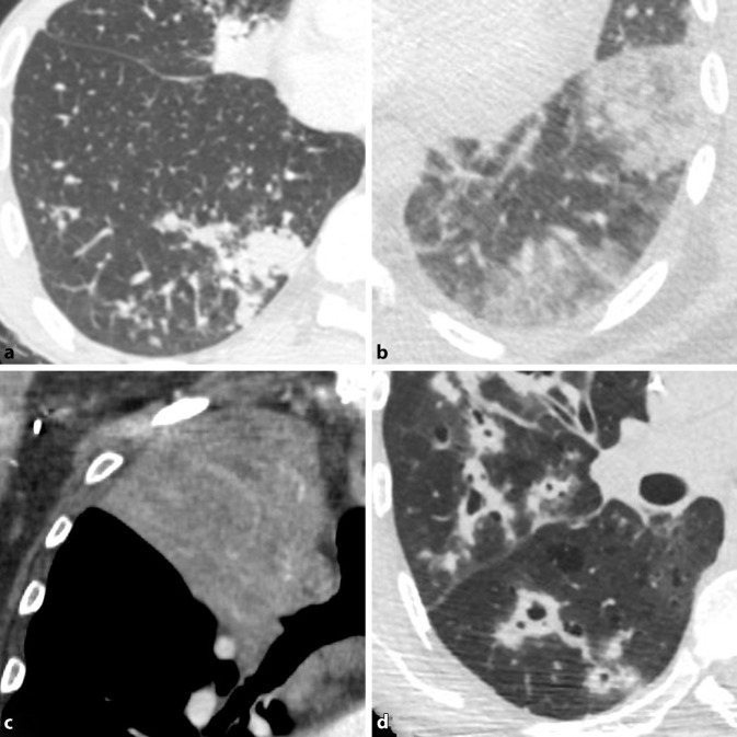 [Imaging in respiratory infections].