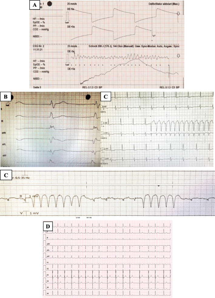 Aborted sudden cardiac death due to ventricular fibrillation in a female patient with mitral valve prolapse.