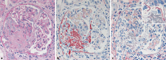 [Creatinine rise, fever and hemoptysis].