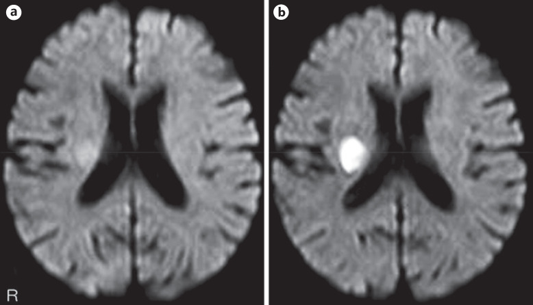 Attack Interval Is the Key to the Likely Pathogenesis of Multiple Transient Ischemic Attacks.